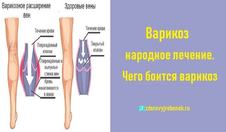 Варикоз Вен На Ногах Народные Средства