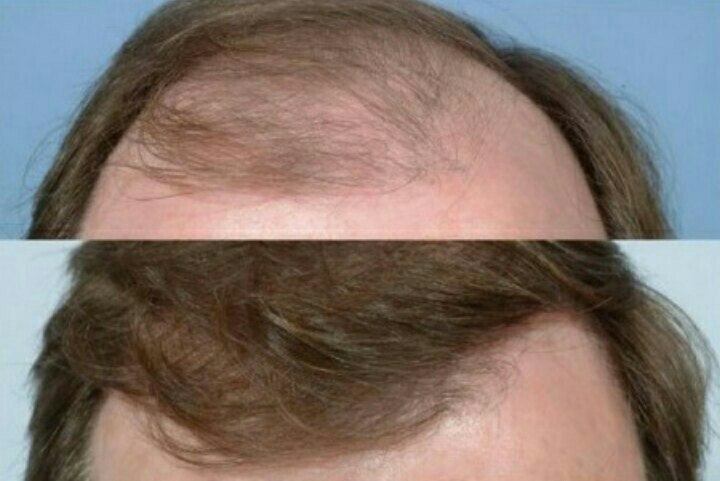 Пересадка волос выпадают волосы. Пересаженные волосы выпадают. После пересадки волос волосы выпадают. Выпадение волос из за тестостерона.