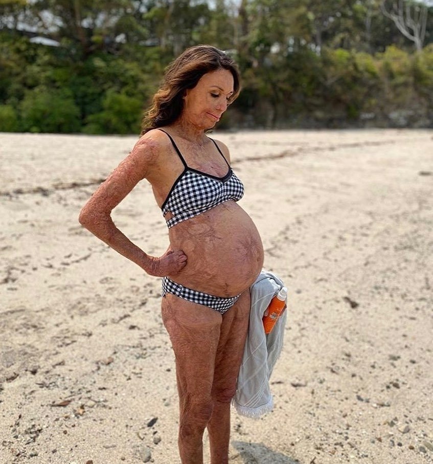 Сколько женщина может родить детей за жизнь. Турия Питт австралийская модель. Модель Турия Питт до пожара.