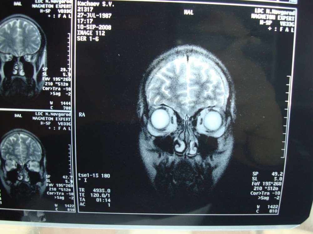 Головные боли мрт или кт. Внутричерепная гипертензия мрт. Мрт головного мозга внутричерепное давление. Внутричерепное давление на мрт головы.
