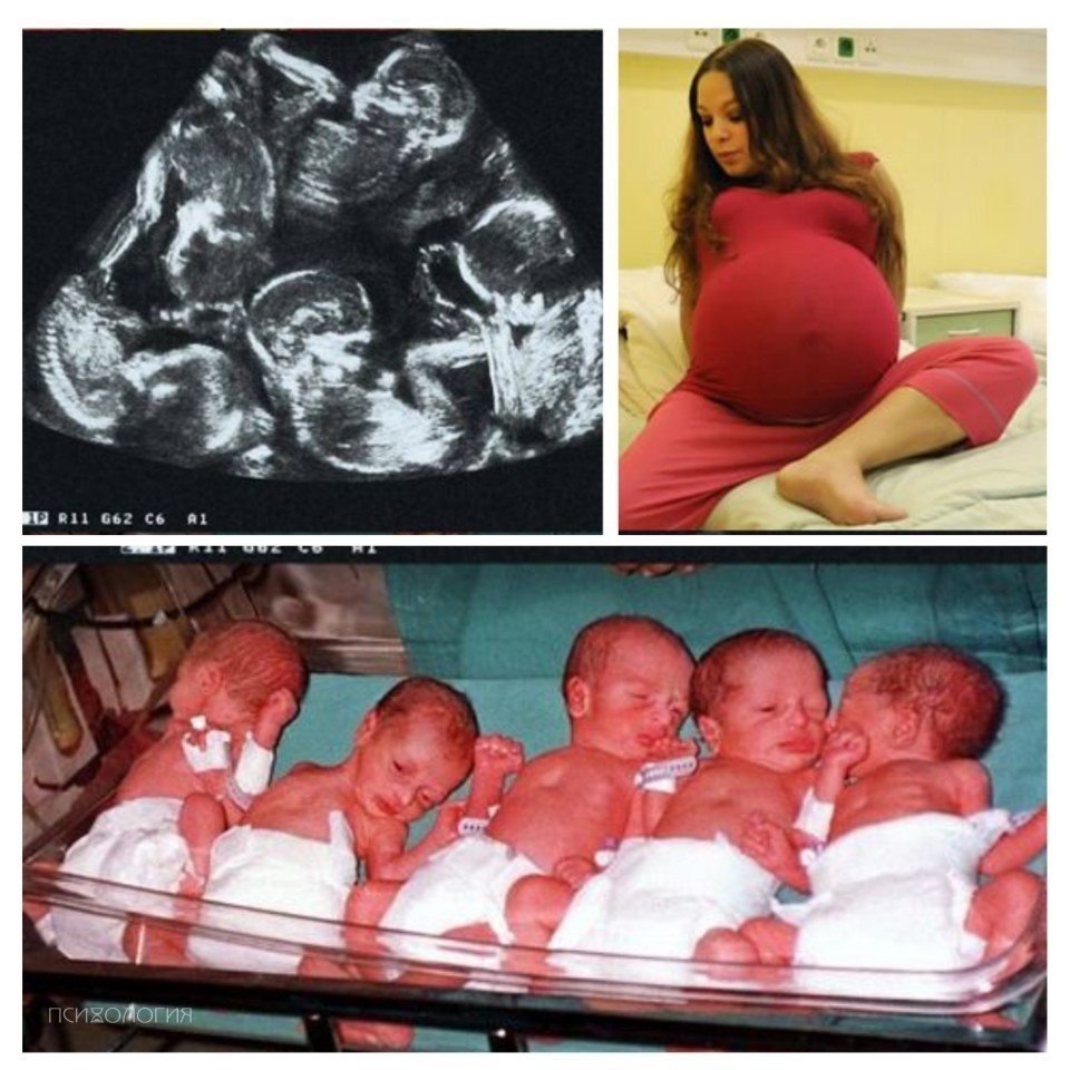 Рождение 5 детей в россии. Пять девочек родились.