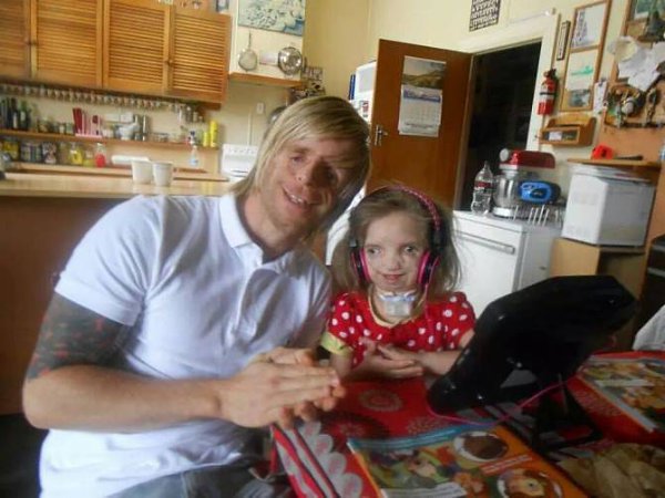 РЕДКИЙ СИНДРОМ ТРИЧЕРА КОЛЛИНЗА.Житель Лондона Джоно Ланкастер (Jono Lancaster) страдает от редкого ... - 10