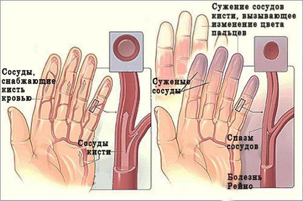 СРЕДСТВА ПРОТИВ ОНЕМЕНИЯ РУК И НОГ. Онемение рук - симптомы, которые могут сопровождать различные ...