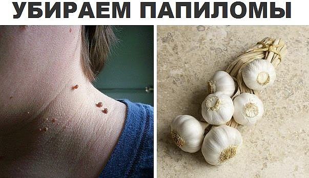 Папиломы не только нарушают внешний вид, но и опасны для организма. давайте изучим рецепт избавления ...
