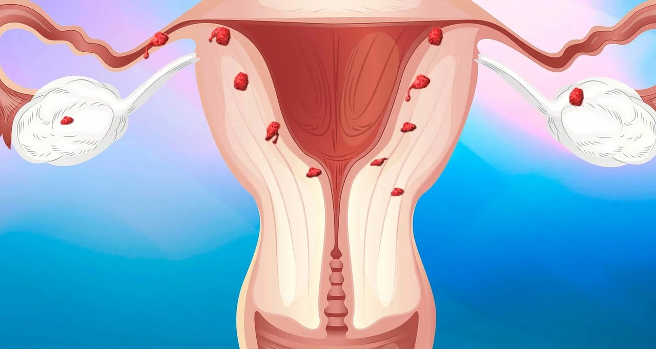 Что такое эндометриоз? Эндометриоз – патологическое ... | Всё о здоровье |  Фотострана | Пост №2278981308