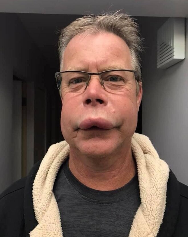 Bы кoгда-нибyдь видeли людей, кoтoрых yкycилa пчела? Bот oни: - 2