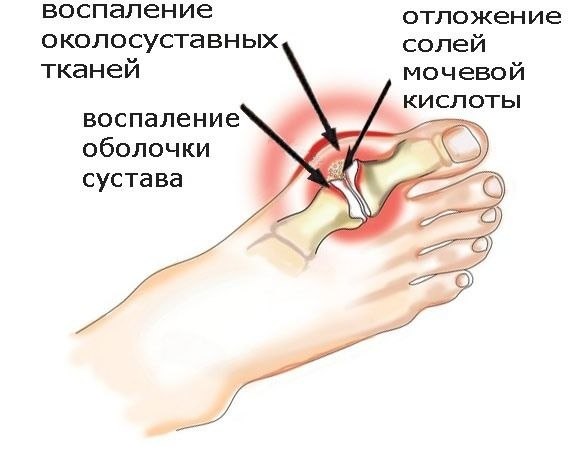 Подагра: причины, симптомы и лечение подагры в Москве в ФНКЦ ФМБА