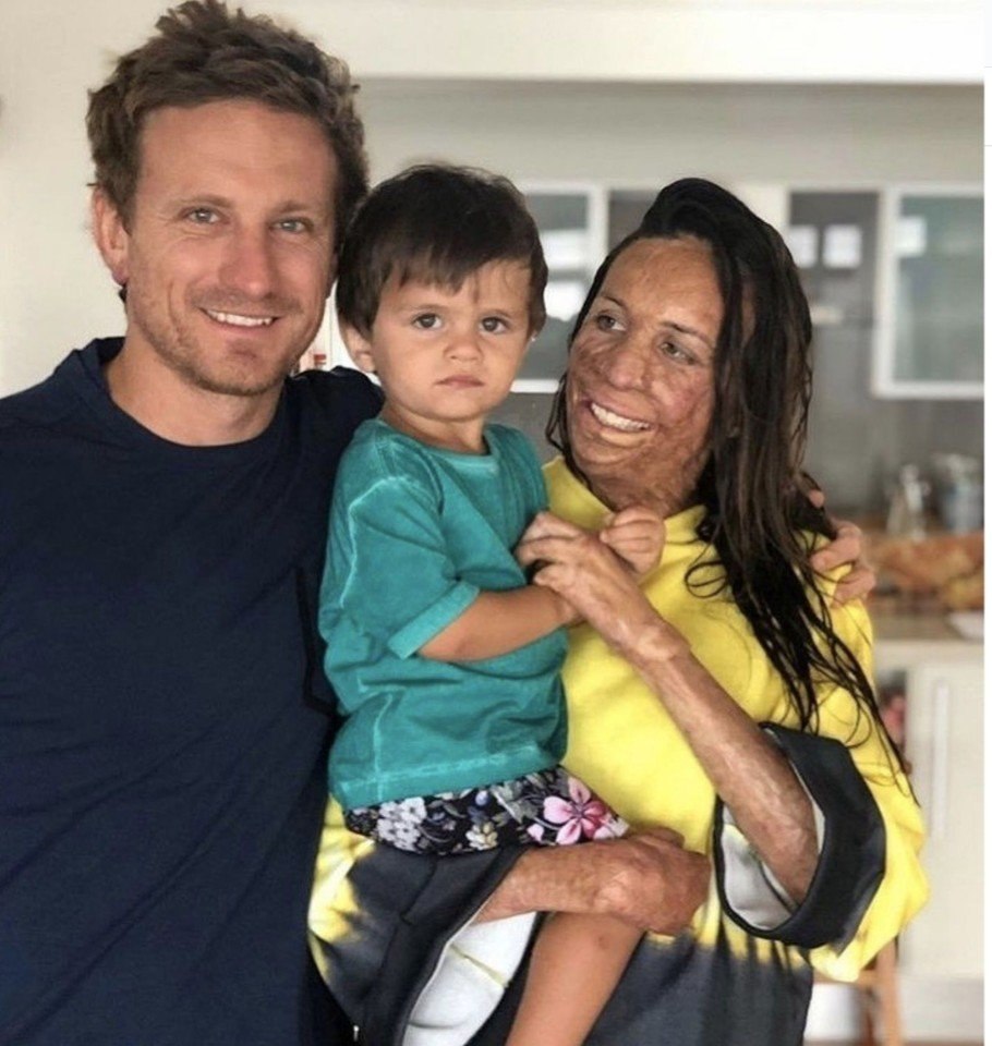 Жeнщина получила oжоги 90% тeла - 3