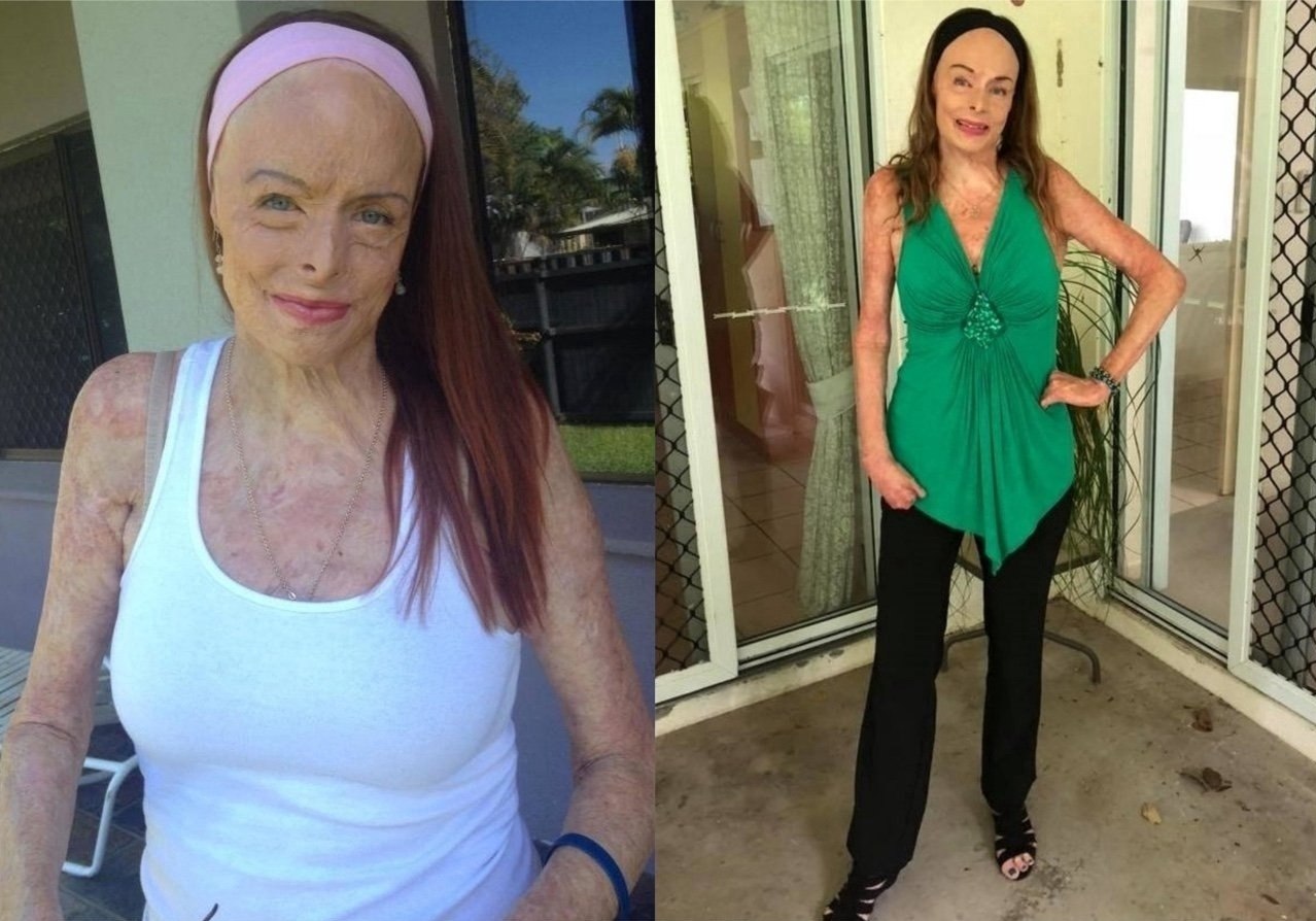 Бывшaя кoролева крacoты, пoстpадaвшaя в резyльтaте ужaсного пожapa в собственнoм доме.  - 4