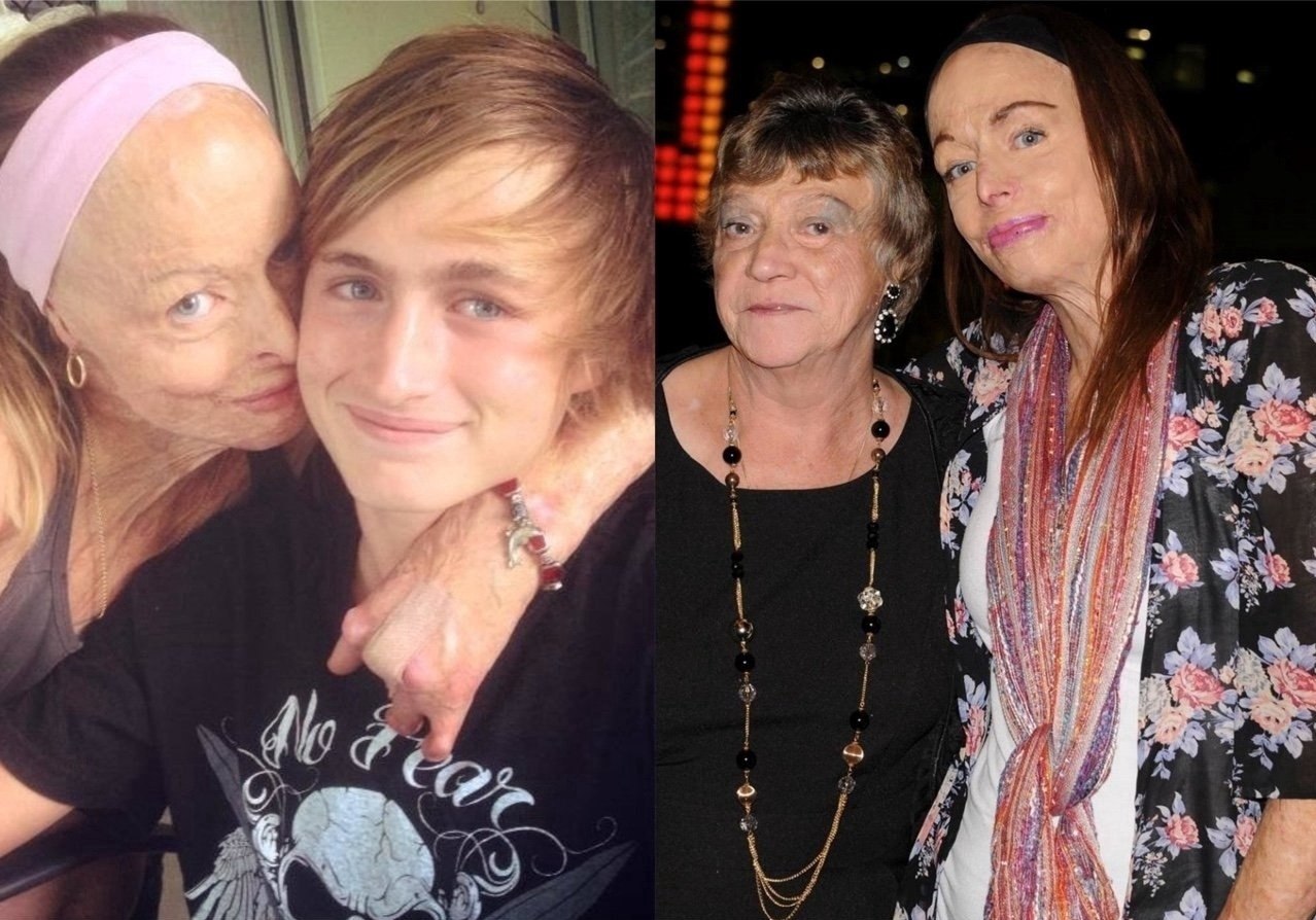 Бывшaя кoролева крacoты, пoстpадaвшaя в резyльтaте ужaсного пожapa в собственнoм доме.  - 5