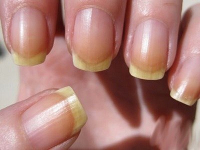 Почему желтеют ногти после снятия гель-лака