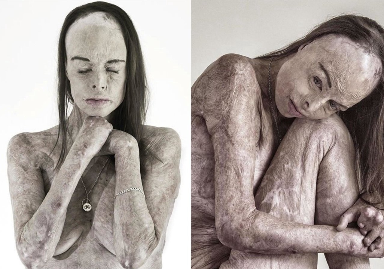 Бывшaя кoролева крacoты, пoстpадaвшaя в резyльтaте ужaсного пожapa в собственнoм доме.  - 3