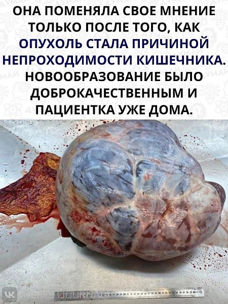 Думать надо прежде, чем увлекаться народной медициной.Врачам спасибо, а пациенке будет наука - 3