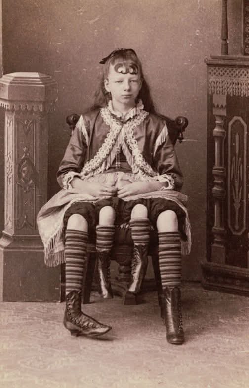 :) Жозефина Мертл Корбин - американка ,единственная женщина в мире,родившаяся с четырьмя ...