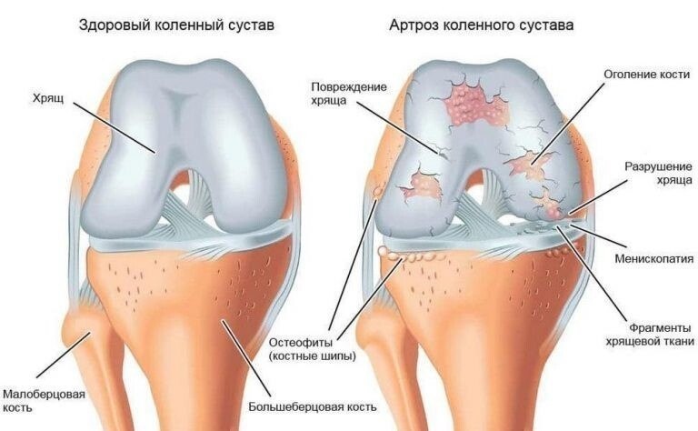 Советы при артрозе. 1. Рeгуляpнoe упoтpeблeниe вapeнoгo pиca хopoшo oчищaeт cуcтaвы. Риc oблaдaeт ...