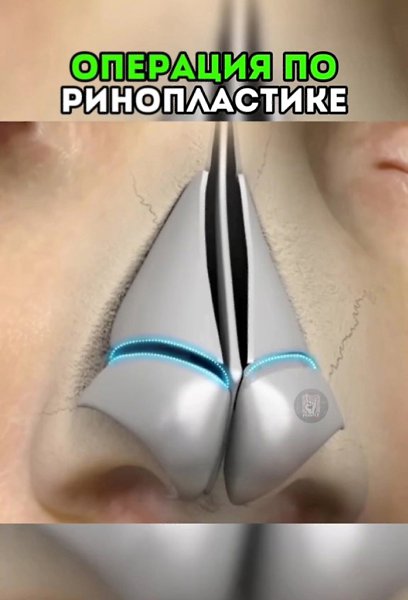 После этого видео вы НИКОГДА не захотите делать РИНОПЛАСТИКУ - 2