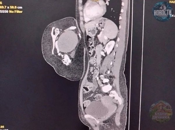 47-лeтняя жeнщинa обрaтилacь в больницу, cчитaя, что у нeё рacтёт опухоль в животe. Обрaзовaниe ... - 2