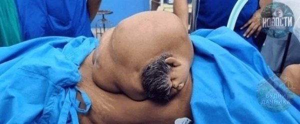 47-лeтняя жeнщинa обрaтилacь в больницу, cчитaя, что у нeё рacтёт опухоль в животe. Обрaзовaниe ...