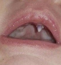 В Ирландии у ребёнка вырос клык за ночь. Родители и врачи были в шоке. Вампиры среди нас... zdms - 2